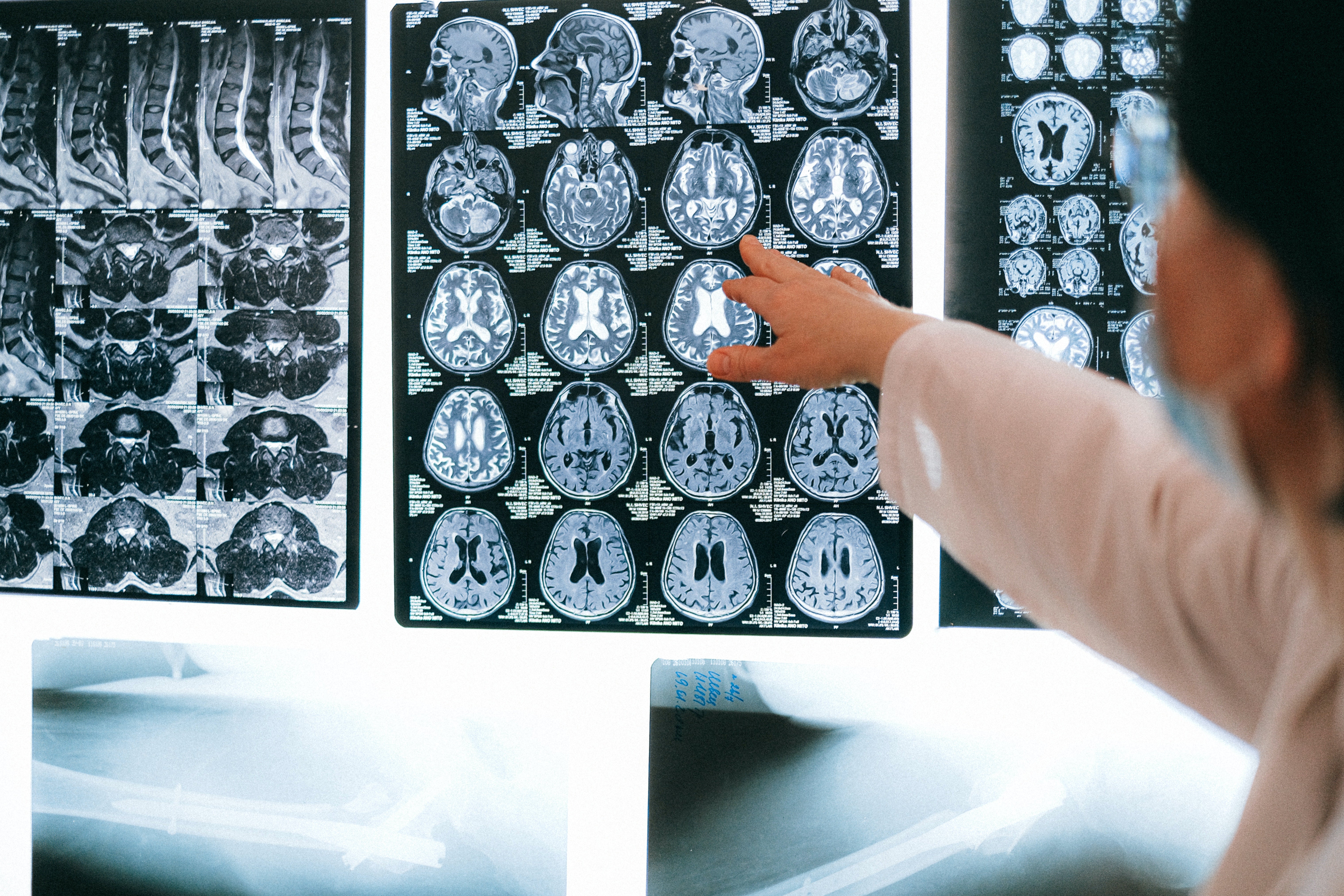 Un paciente con ELA consigue volver a comunicarse gracias a un implante cerebral Un paciente con ELA consigue volver a comunicarse gracias a un implante cerebral