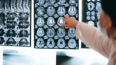 Imagen de archivo de una placa cerebral.