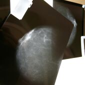 Una radiografía de una mama