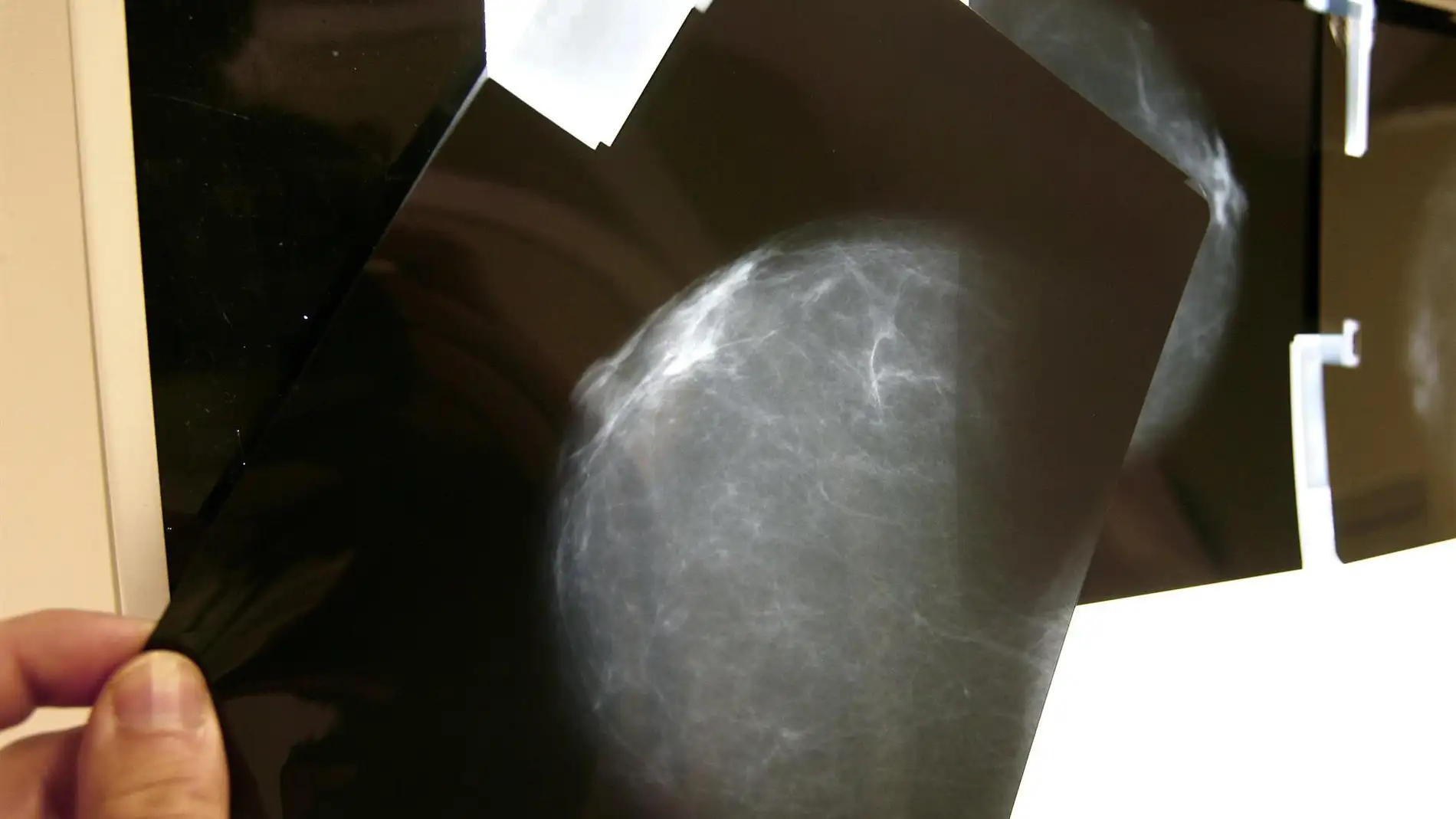 Una radiografía de una mama | Foto: EFE/ Chema Moya