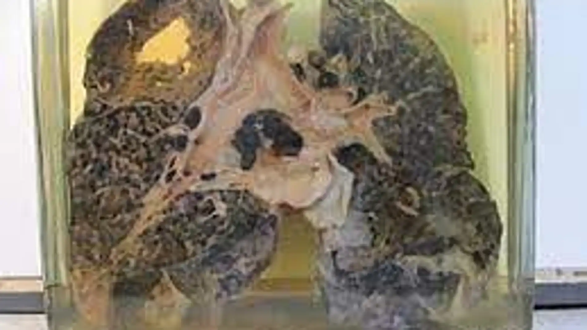 Pulmones afectados de silicosis