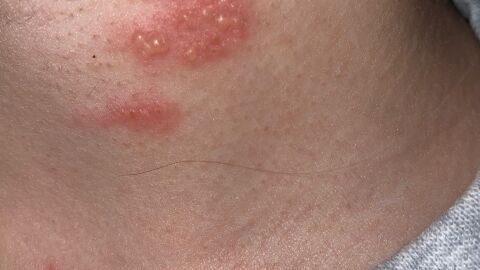 Herpes Z&oacute;ster