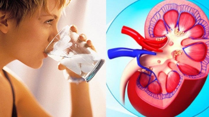 Los hábitos de vida saludables y beber bastante agua previenen la litiasis renal Los hábitos de vida saludables y beber bastante agua previenen la litiasis renal