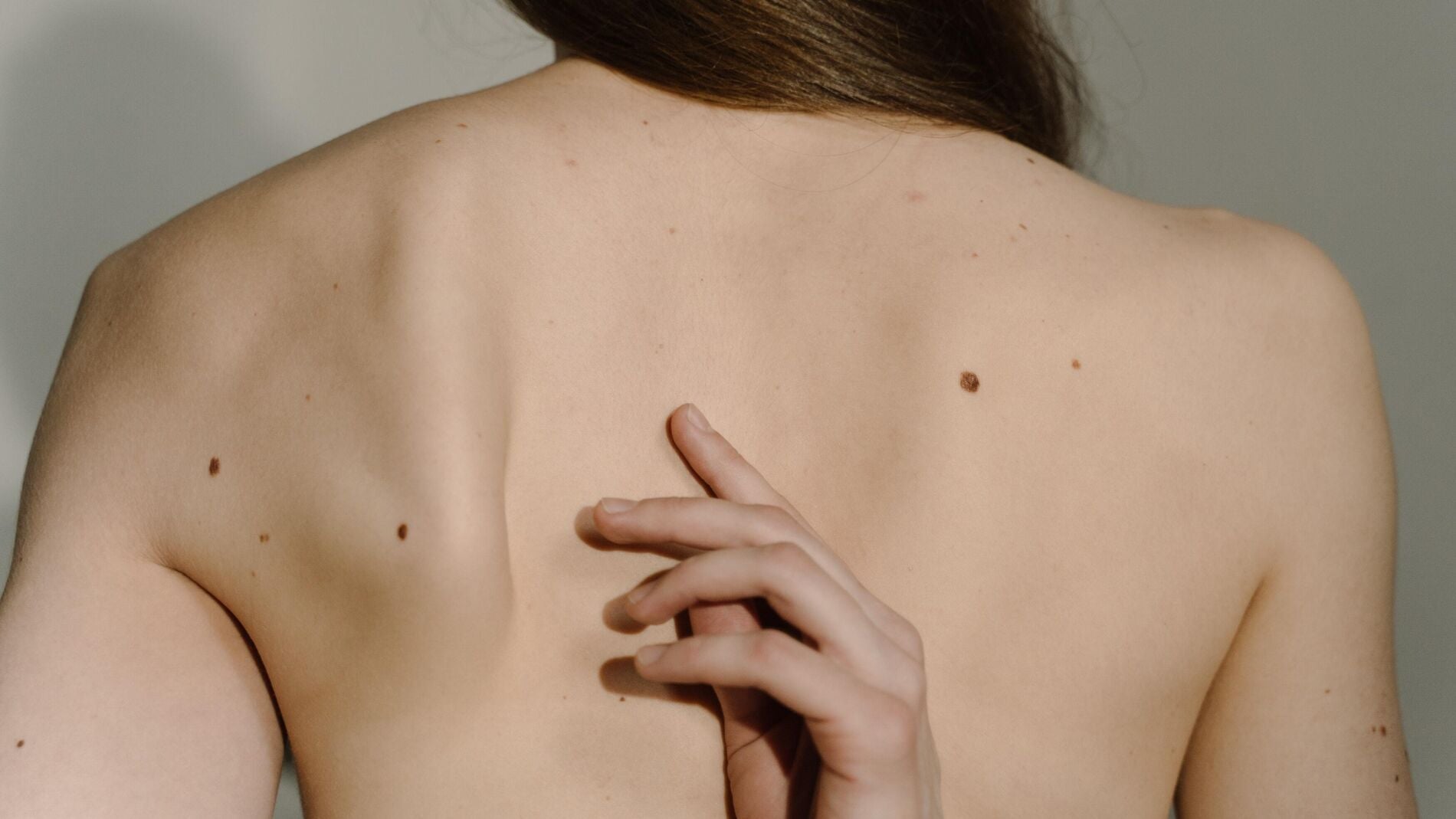 Es importante revisarse los lunares de la piel para prevenir el melanoma