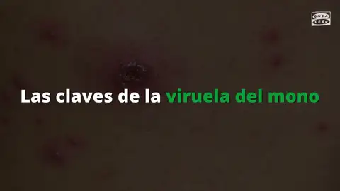Qué es el exantema vesicular, el preocupante síntoma que puede indicar el contagio por viruela del mono Qué es el exantema vesicular, el preocupante síntoma que puede indicar el contagio por viruela del mono