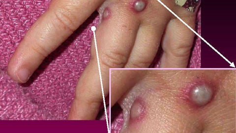 Qu&eacute; es el exantema vesicular, el preocupante s&iacute;ntoma que puede indicar el contagio por viruela del mono