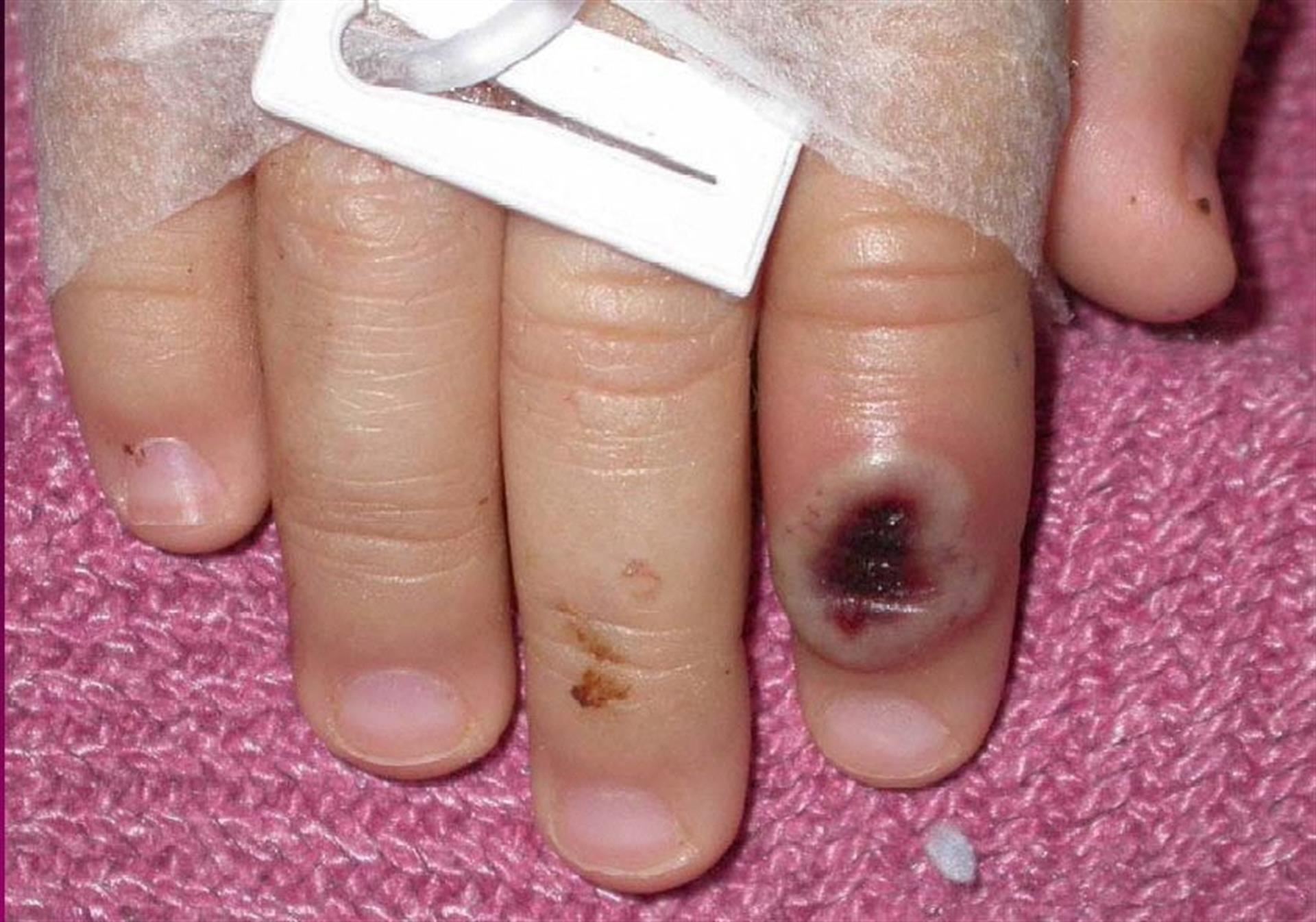 Confirmado 2º caso de viruela del mono en Extremadura sin relación epidemiológica con el primero Confirmado 2º caso de viruela del mono en Extremadura sin relación epidemiológica con el primero