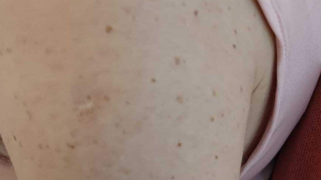 Así es la cicatriz de la vacuna contra la viruela Así es la cicatriz de la vacuna contra la viruela