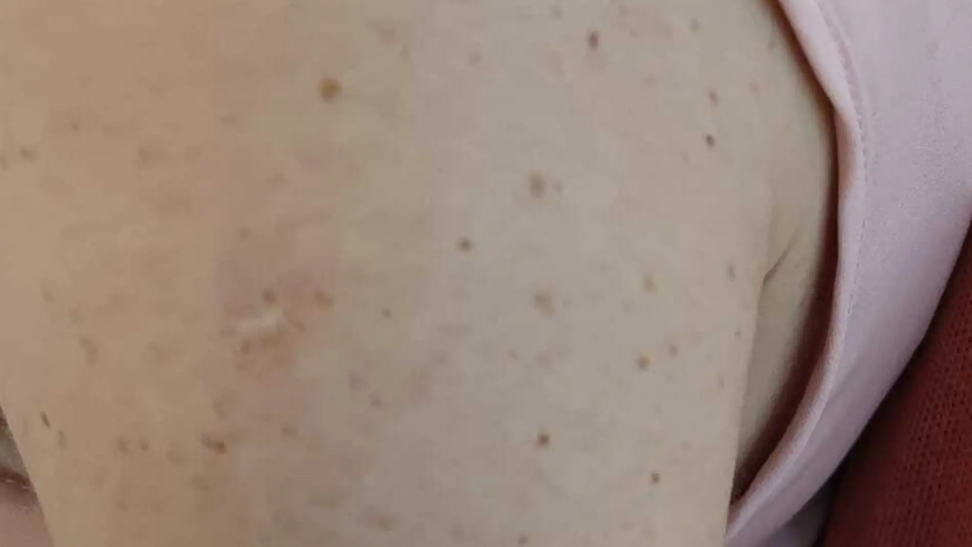 Así es la cicatriz de la vacuna contra la viruela 