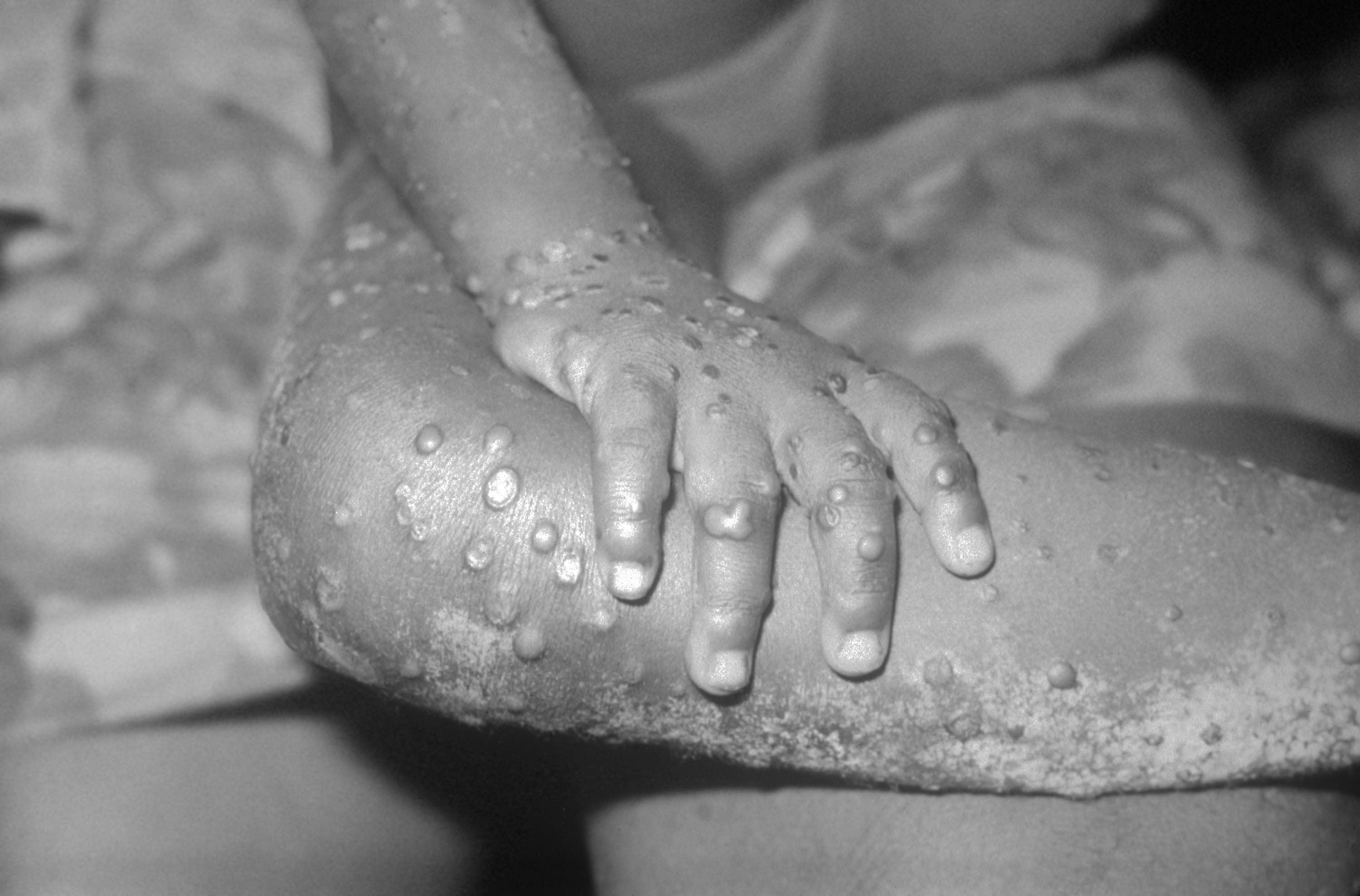 Viruela del mono: Se elevan a 84 los casos confirmados en España de monkeypox Viruela del mono: Se elevan a 84 los casos confirmados en España de monkeypox
