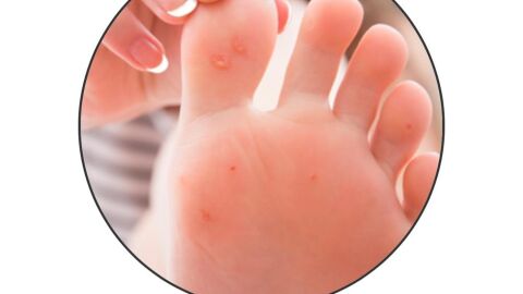 Verruga plantar