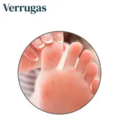 Verruga plantar Verruga plantar