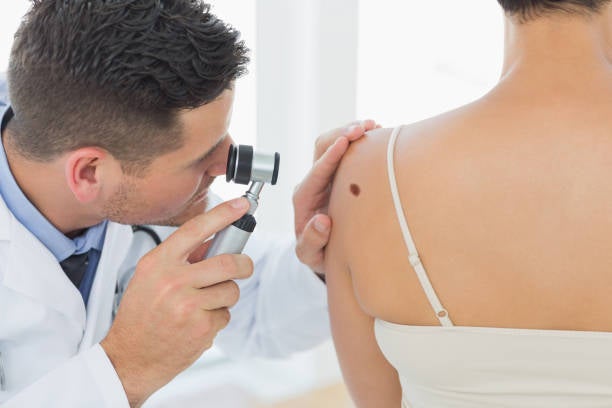 Cada año se diagnostican 140 casos de melanoma en Aragón Cada año se diagnostican 140 casos de melanoma en Aragón