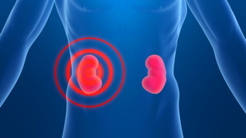 La silenciosa invasi&oacute;n de la enfermedad renal