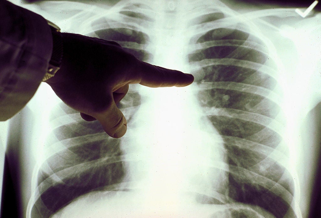 Radiografía de los pulmones Radiografía de los pulmones