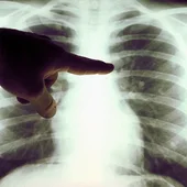 Radiografía de los pulmones Radiografía de los pulmones