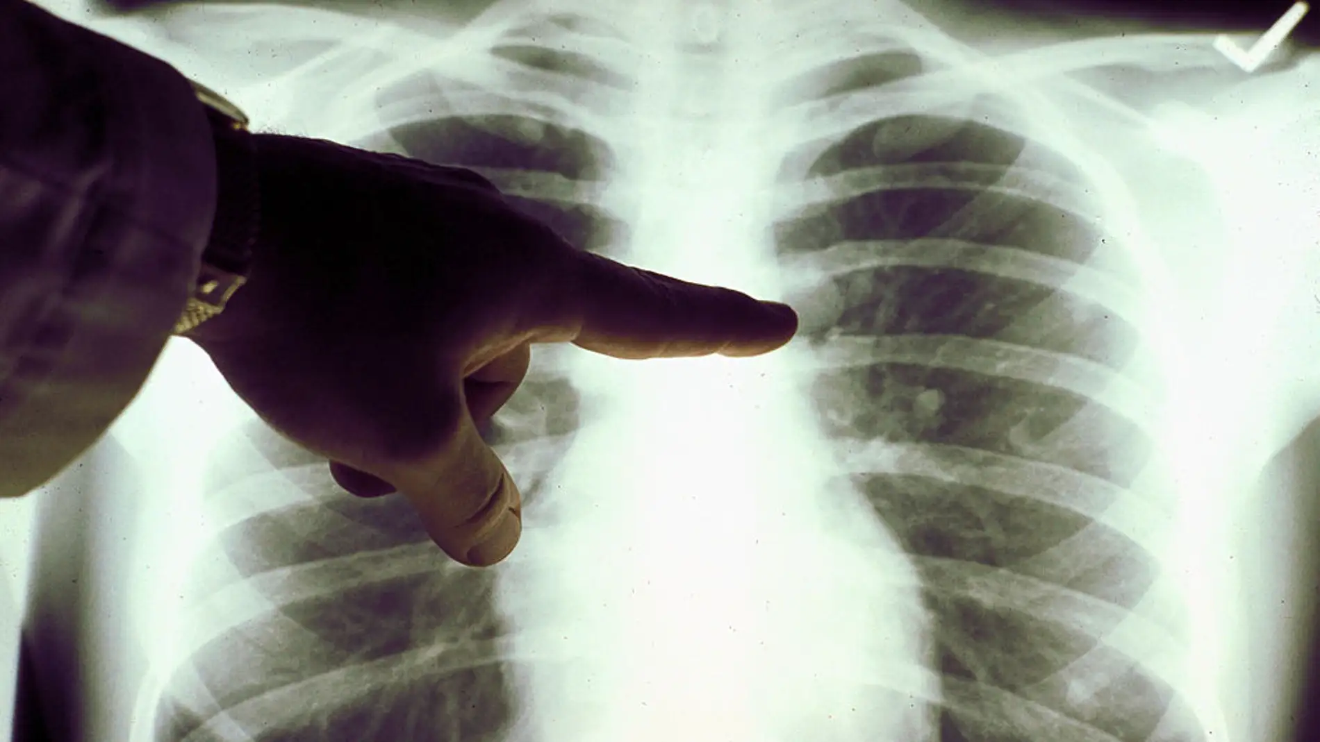 Radiografía de los pulmones.
