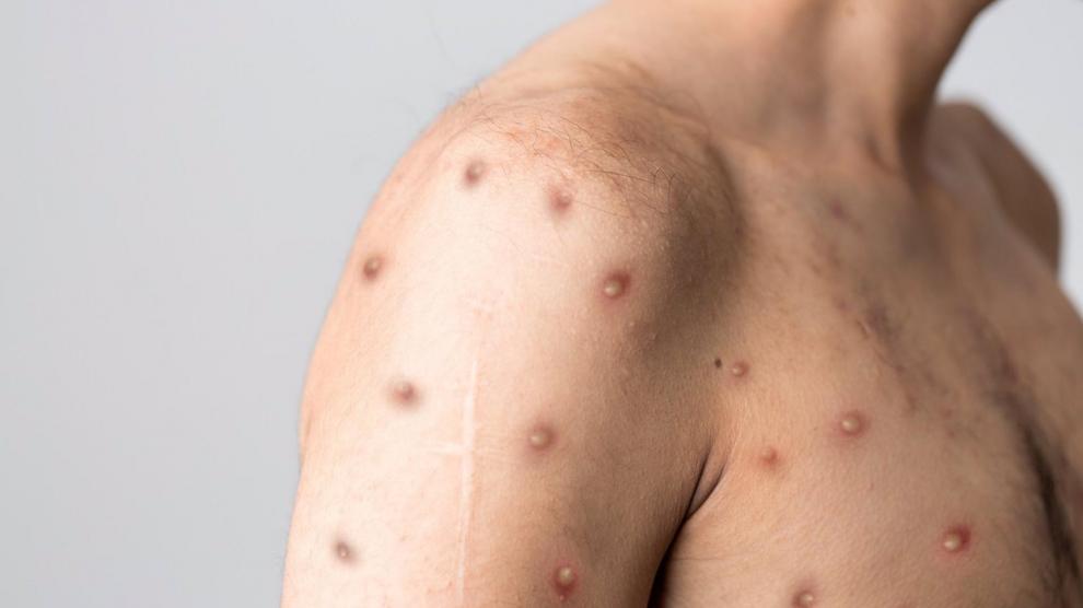 Euskadi mantiene las recomendaciones de vacunación y apuesta por la vigilancia epidemiológica para hacer frente a MonkeyPox Euskadi mantiene las recomendaciones de vacunación y apuesta por la vigilancia epidemiológica para hacer frente a MonkeyPox
