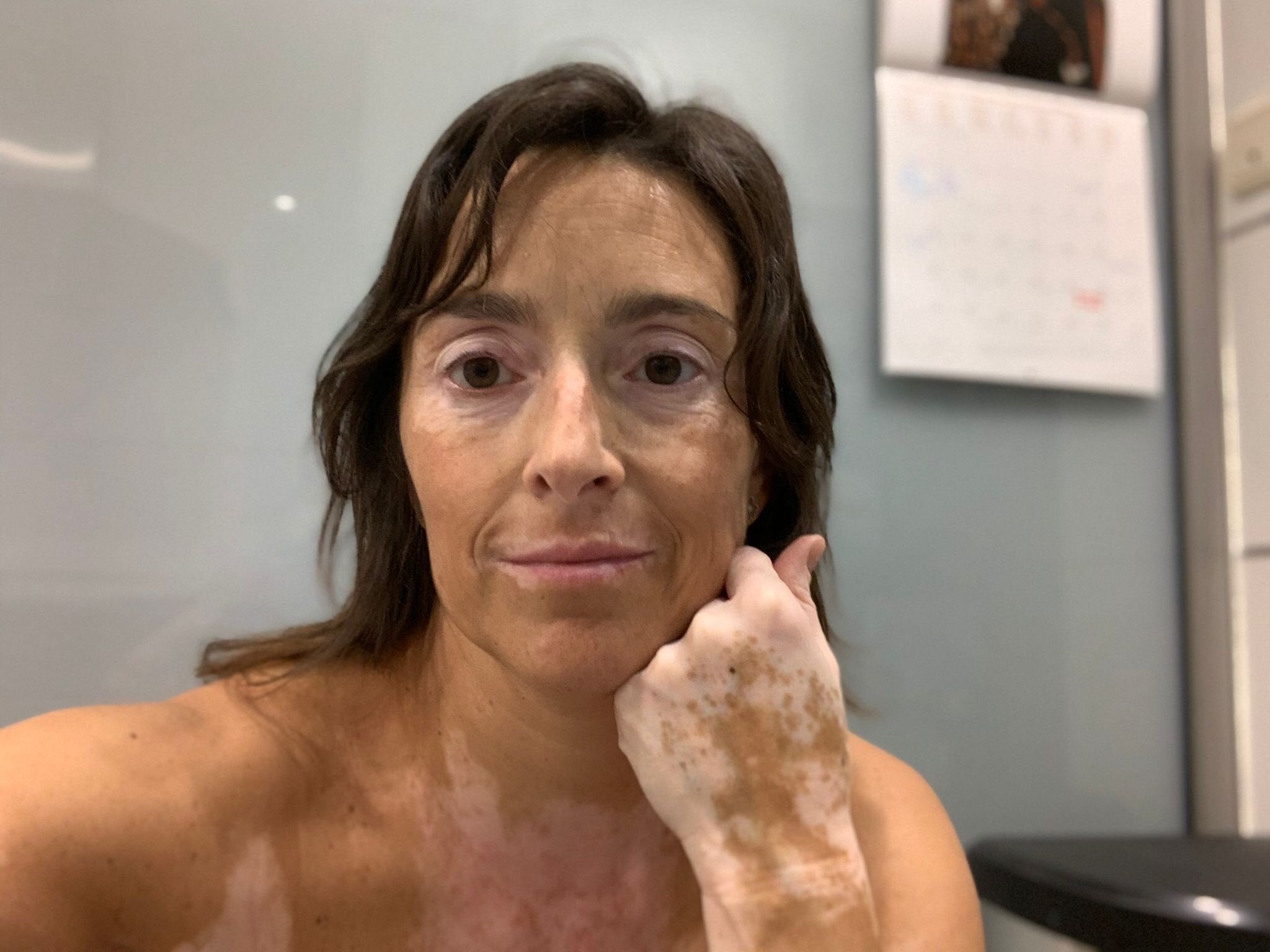 Así es vivir con vitíligo: "Llegué a pensar que era similar al cáncer de piel y me aterraba" Así es vivir con vitíligo: "Llegué a pensar que era similar al cáncer de piel y me aterraba"