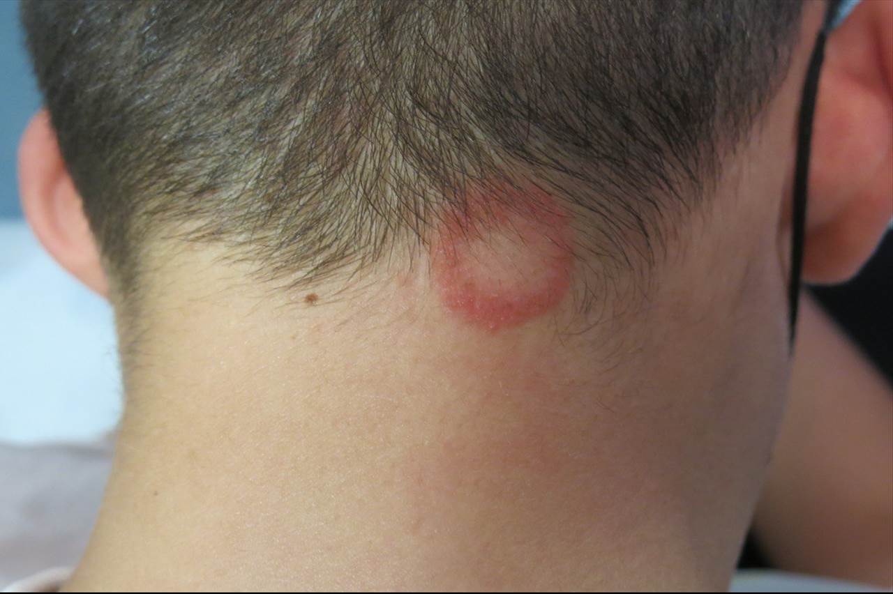 Así es la tiña: las fotos con las que los dermatólogos alertan del brote de esta infección Así es la tiña: las fotos con las que los dermatólogos alertan del brote de esta infección