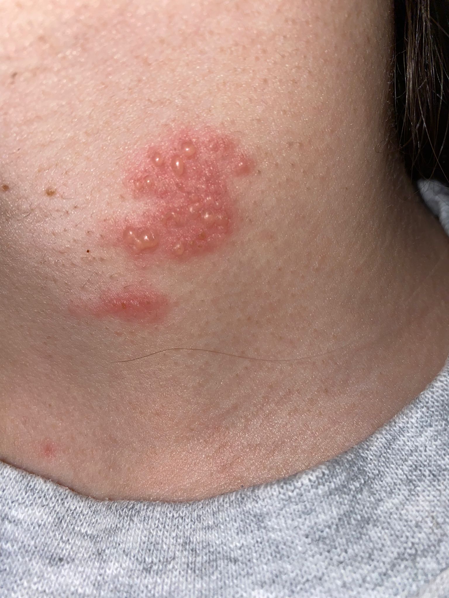 Los síntomas del herpes zoster: cómo se contagia Los síntomas del herpes zoster: cómo se contagia