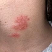 Los síntomas del herpes zoster: cómo se contagia