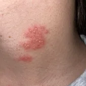 Los síntomas del herpes zoster: cómo se contagia Los síntomas del herpes zoster: cómo se contagia