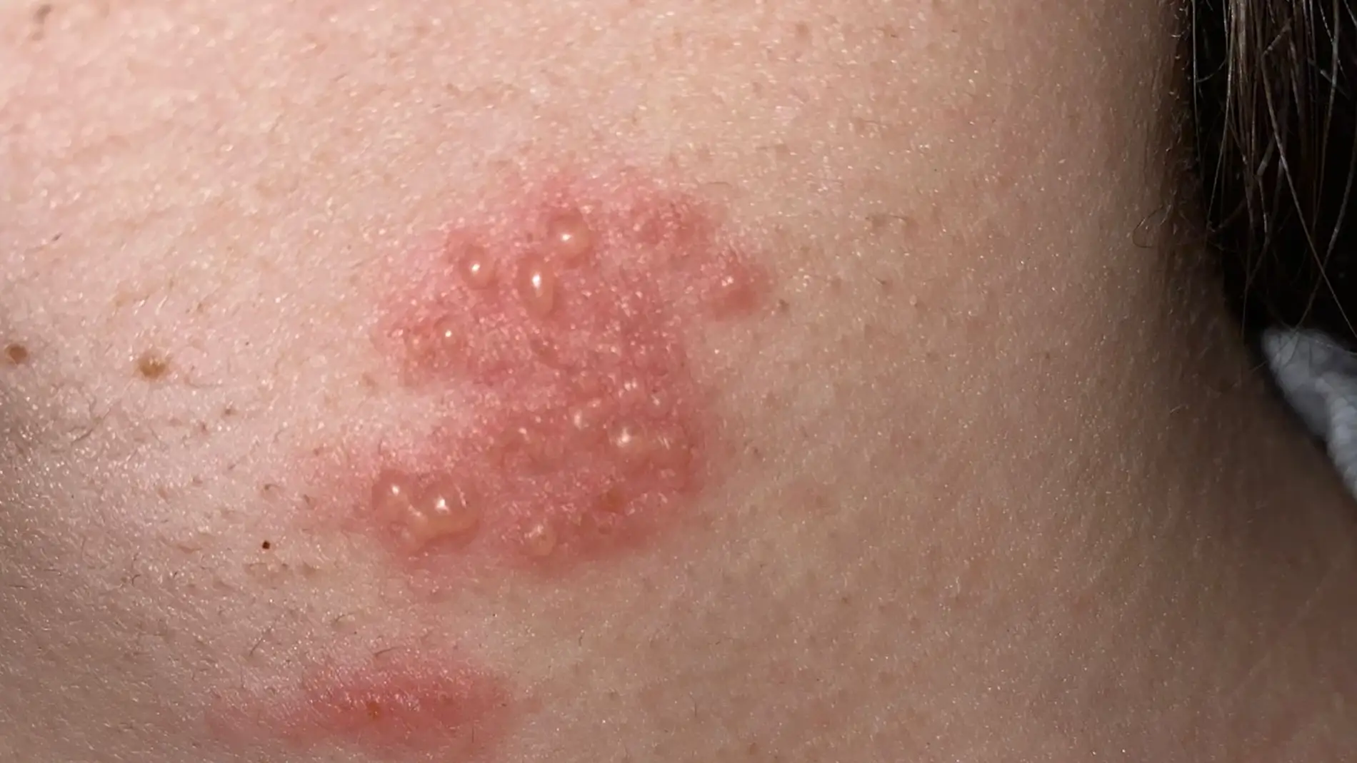 Los síntomas del herpes zoster: cómo se contagia