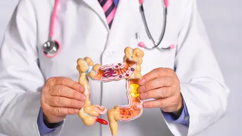 Cáncer de Colon Cáncer de Colon