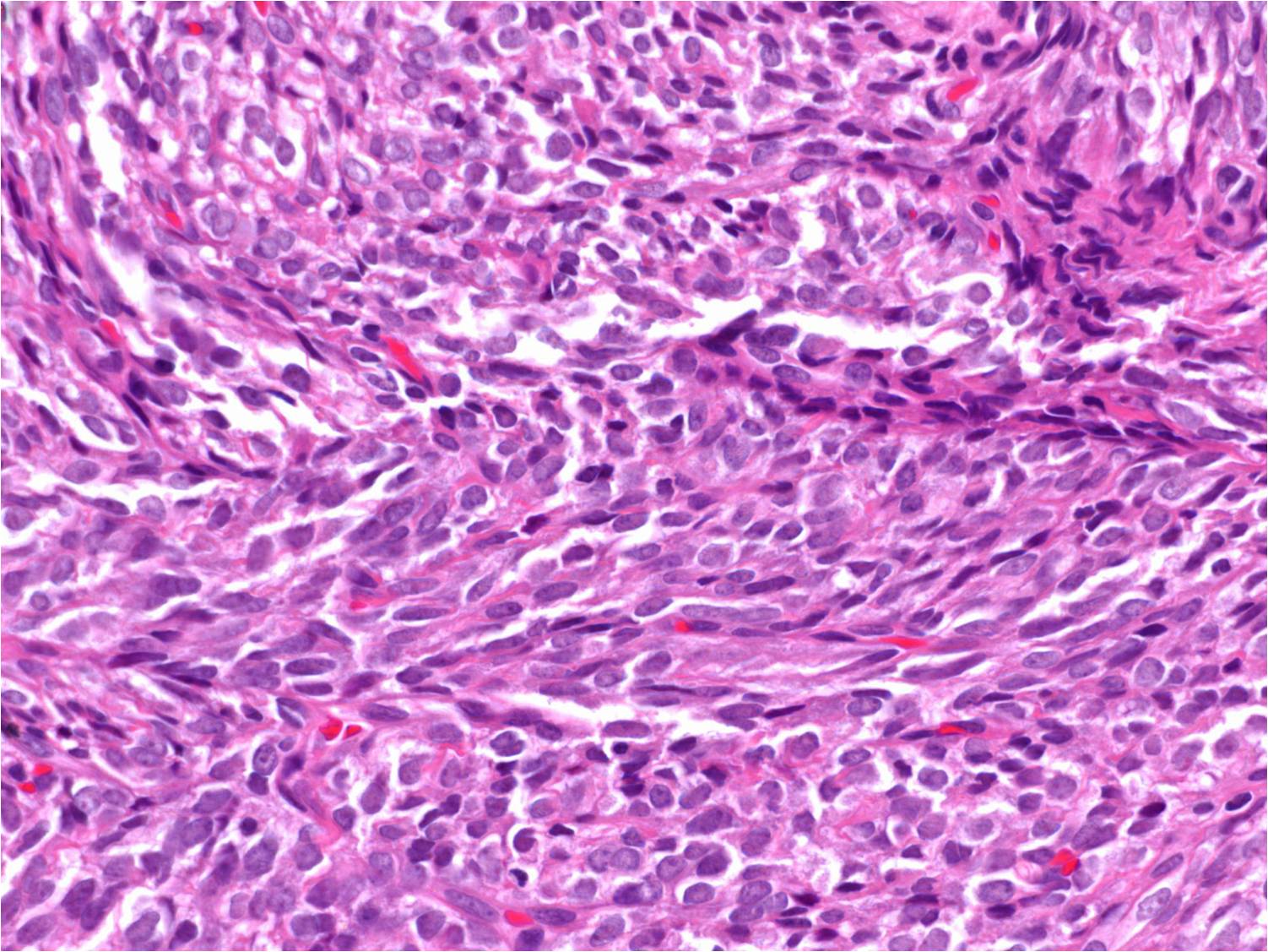 La importancia de contar en Aragón con una Unidad de Referencia para atender a pacientes con sarcoma La importancia de contar en Aragón con una Unidad de Referencia para atender a pacientes con sarcoma