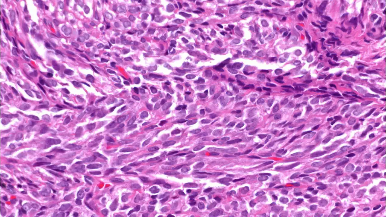 Sarcoma Sinovial Sarcoma Sinovial