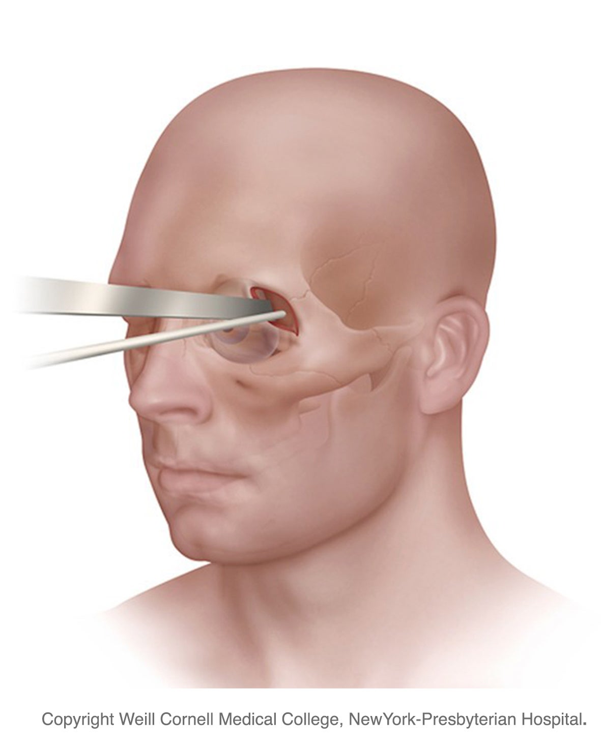 Realizadas con éxito en Navarra las primeras intervenciones para extirpar tumores cerebrales a través de la órbita ocular Realizadas con éxito en Navarra las primeras intervenciones para extirpar tumores cerebrales a través de la órbita ocular