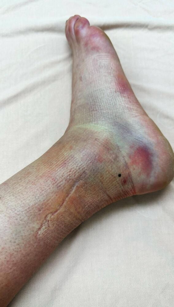 Pie lesionado de Ariadna Ródenas
