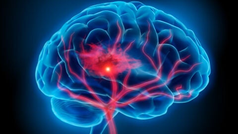 accidente cerebrovascular