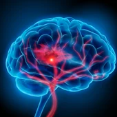 accidente cerebrovascular accidente cerebrovascular