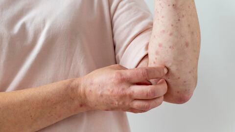 Un brote de sarampi&oacute;n pone en alerta a Europa: cu&aacute;les son los s&iacute;ntomas de esta enfermedad