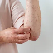 Un brote de sarampión pone en alerta a Europa: cuáles son los síntomas de esta enfermedad Un brote de sarampión pone en alerta a Europa: cuáles son los síntomas de esta enfermedad