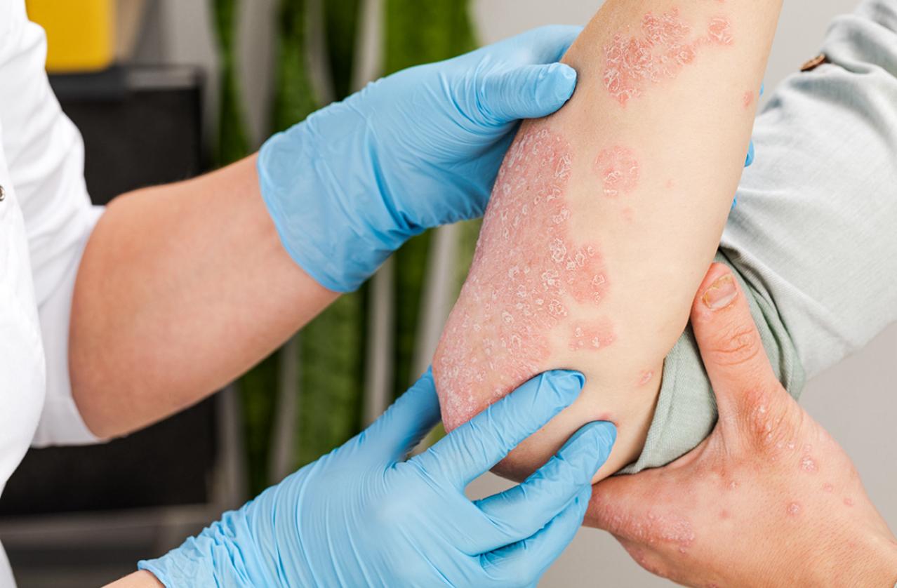 La psoriasis no es peligrosa y no se contagia, su aparición se debe a una enfermedad autoinmune que se puede tratar La psoriasis no es peligrosa y no se contagia, su aparición se debe a una enfermedad autoinmune que se puede tratar