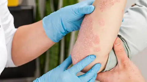 Psoriasis Psoriasis