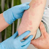 Psoriasis Psoriasis