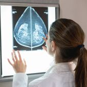 cáncer de mama, diagnóstico