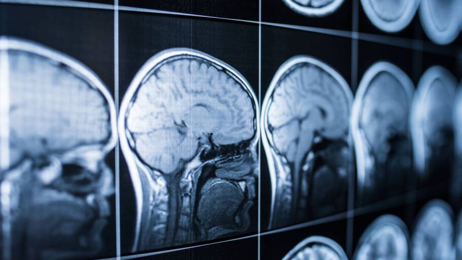 neuroimagen del cerebro