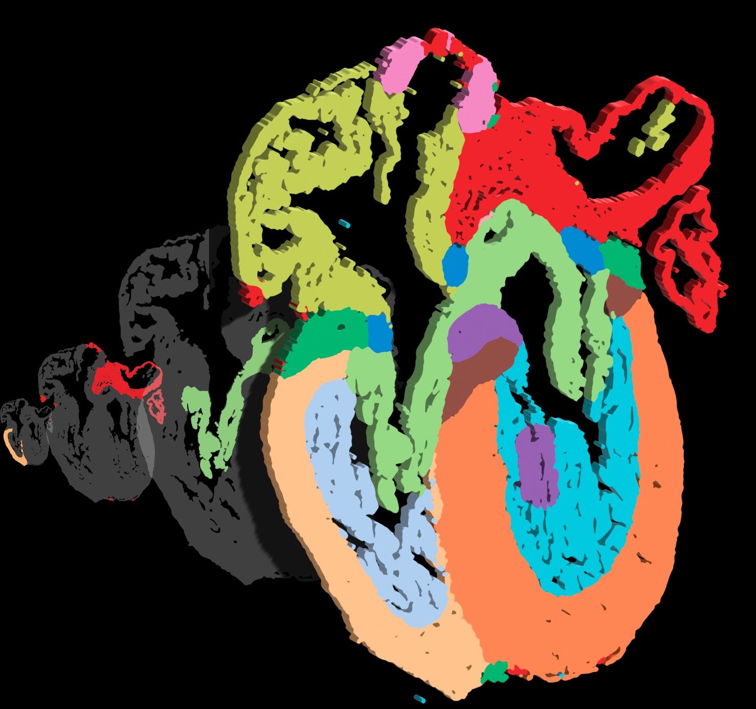 Tako-Tsubo o síndrome de corazón roto Tako-Tsubo o síndrome de corazón roto