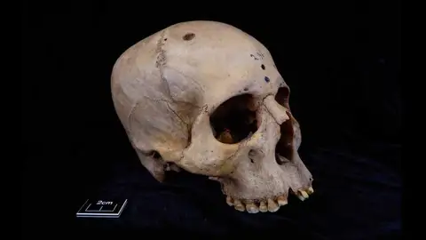 cráneo egipcio con cáncer cráneo egipcio con cáncer