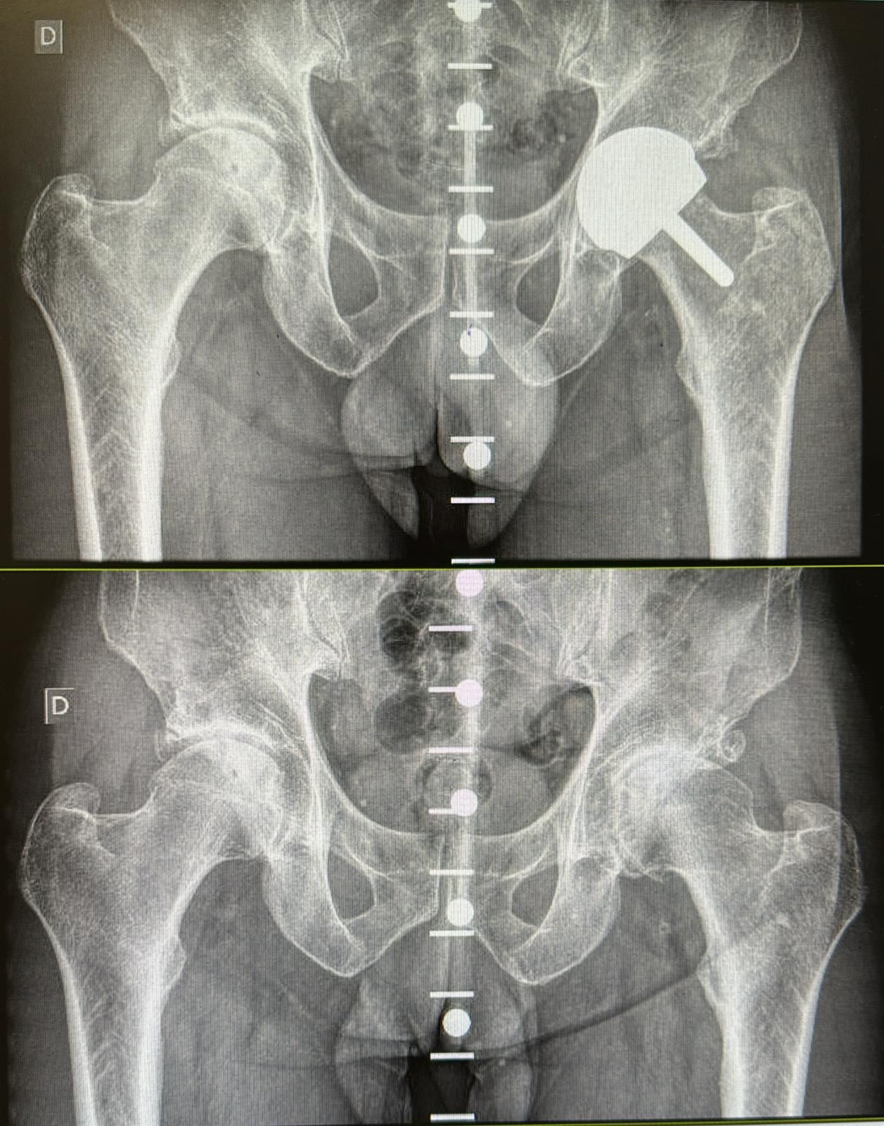 Quirónsalud Sagrado Corazón incorpora un software 3D para la colocación más precisa de prótesis de cadera Quirónsalud Sagrado Corazón incorpora un software 3D para la colocación más precisa de prótesis de cadera