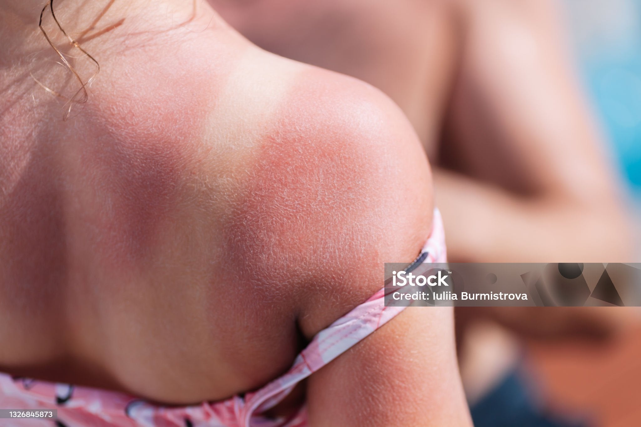 03X28 Quemaduras 03X28 Quemaduras