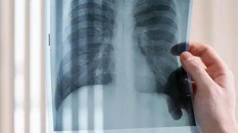 Esto es lo único que los neumólogos te ruegan que no hagas nunca Esto es lo único que los neumólogos te ruegan que no hagas nunca