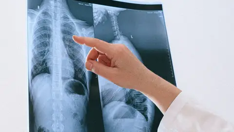 Radiografía de pulmón. Radiografía de pulmón.