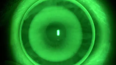 Adaptación óptima de una lente de ortoqueratología Adaptación óptima de una lente de ortoqueratología