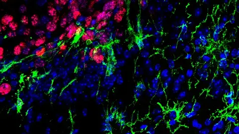 La imagen muestra las células de la microglía (en verde) infiltrándose entre las células tumorales de una metástasis de melanoma (en rojo). Los núcleos de las células están marcados en azul. La imagen muestra las células de la microglía (en verde) infiltrándose entre las células tumorales de una metástasis de melanoma (en rojo). Los núcleos de las células están marcados en azul.
